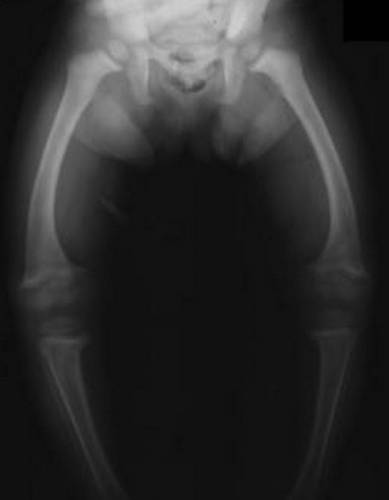 Рентген варусного искривления коленных суставов