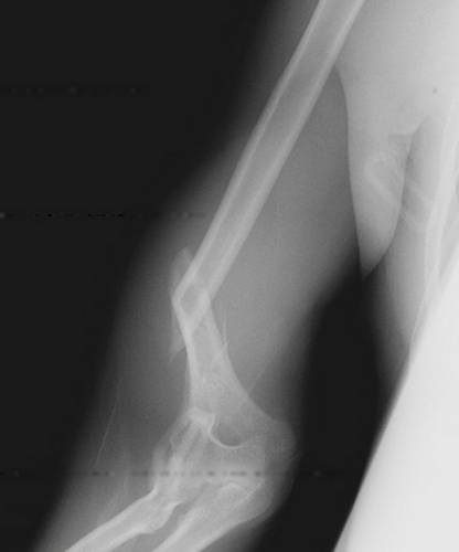 Перелом кости плеча – рентгеновский снимок