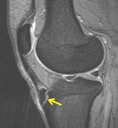 Рентгеновский снимок колена при болезни Осгуда-Шлаттера