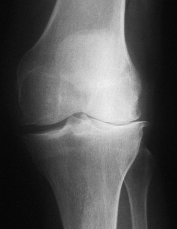 Остеоартроз колена с вальгусной деформации