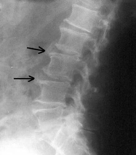 Рентгеновский снимок при гиперостозе позвоночника