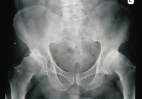 Артроз тазобедренного сустава – рентген-снимок