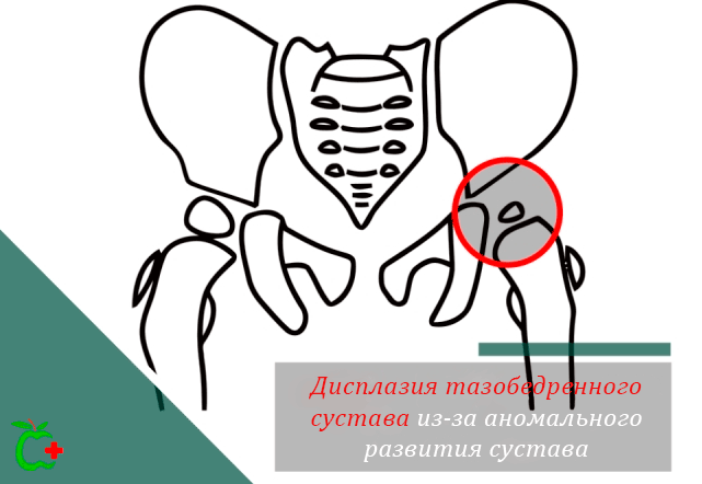 Дисплазия тазобедренного сустава из-за аномального развития сустава