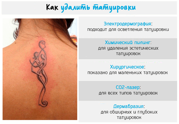 Какими методами удаляют татуировки