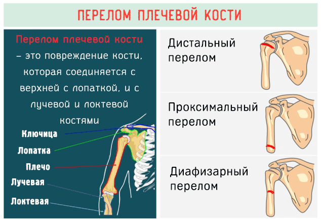Перелом плечевой кости – это повреждение кости которая соединяется с лопаткой