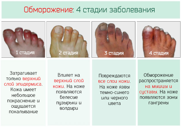 4 стадии обморожения кожи на пальцах ног