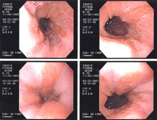 Эзофагогастродуоденоскопия – снимок пищевода