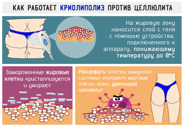 Как работает криолиполиз против целлюлита