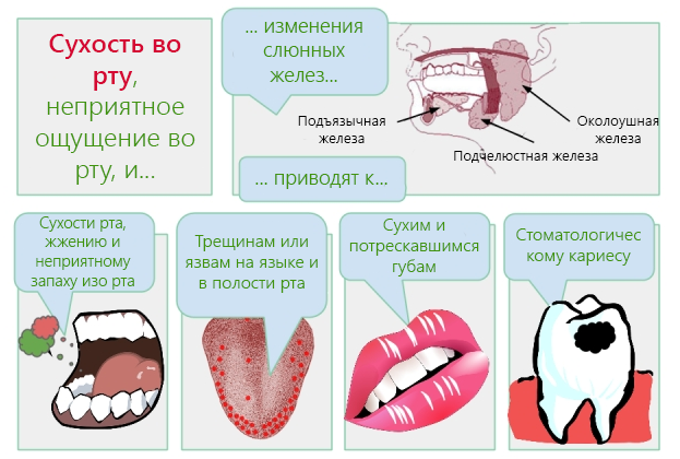 К чему приводит сухость рта – ксеростомия
