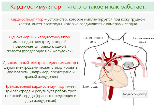 Какие виды кардиостимуляторов используются для стимуляции сердца