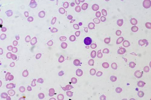 Мазок крови при железодефицитной анемии