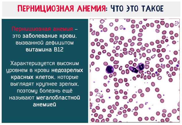 Пернициозная анемия – это заболевание крови вызванной дефицитом витамина В12