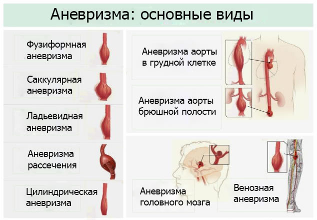 Классификация аневризм кровеносных сосудов