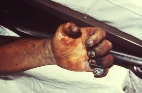 Рука пораженная септической формой чумы