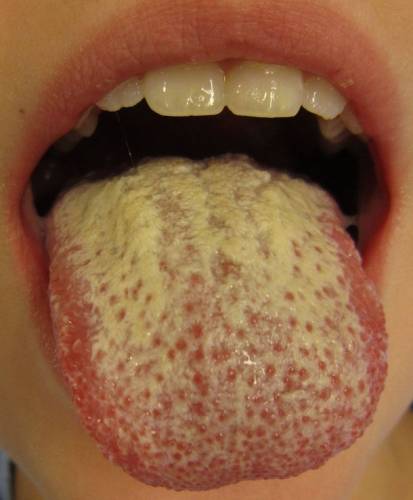 Кандидоз языка и полости рта