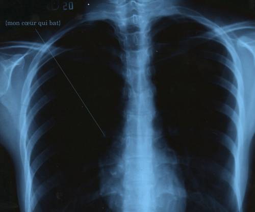 Рентген грудной клетки больного бронхитом
