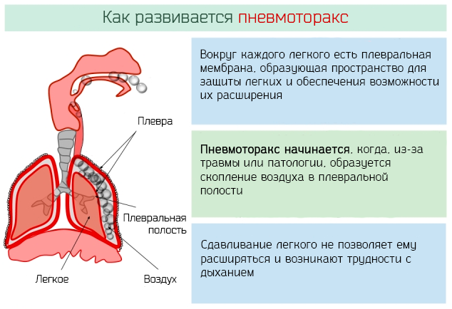 Пневмоторакс начинается из-за травмы или патологии при скоплении воздуха в плевральной полости