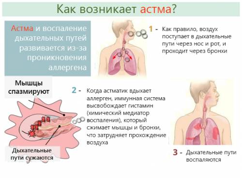 Три стадии развития бронхиальной астмы