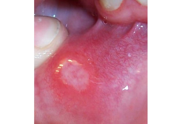 Афты в полости рта – причины изъязвления слизистой оболочки