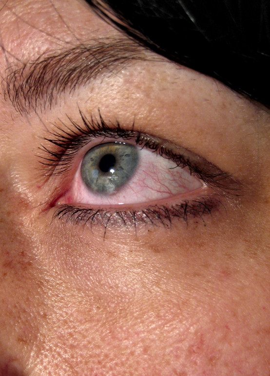 Какие аллергические реакции могут затрагивать глаза
