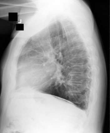 Рентгенограмма грудной клетки больного с асбестозом
