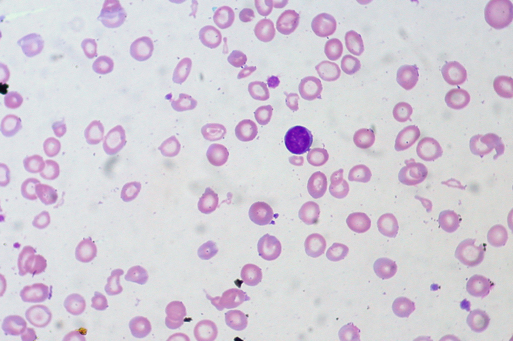 Какие встречаются типы анемии крови – основные различия
