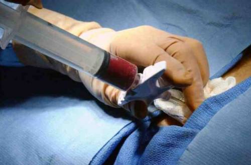 Трансплантация костного мозга – типы и процесс операции