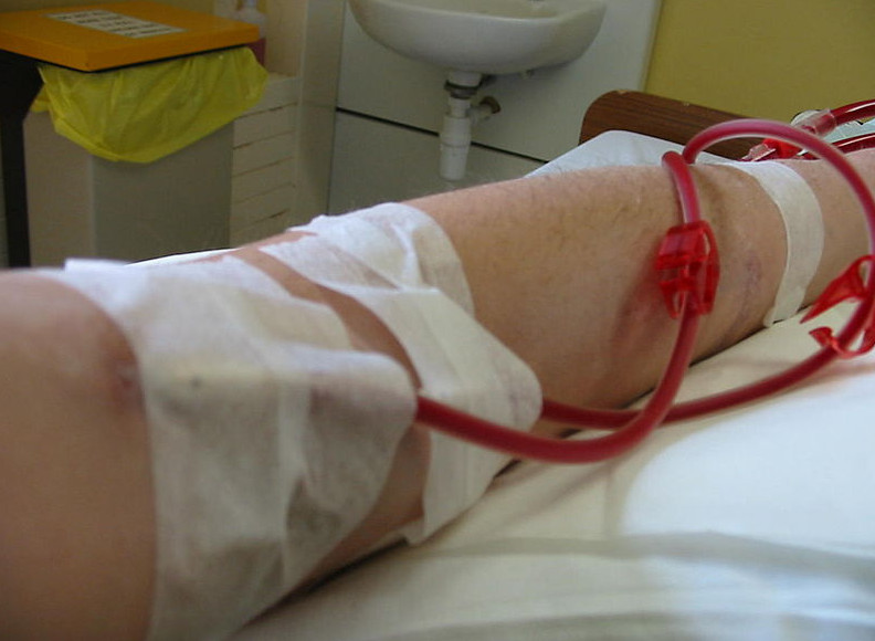 Показания к очищению крови через процедуру гемофереза