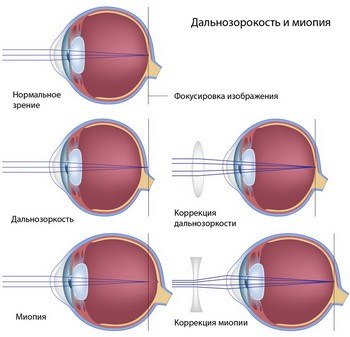 Дефекты зрения: дальнозоркость – осложнения, коррекция, подбор очков и контактных линз