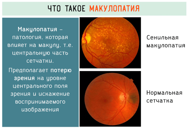 Макулопатия глаза – как проявляется и какие средства помогут сохранить зрение