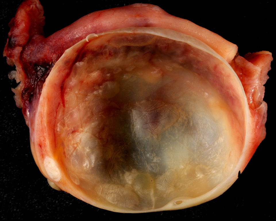 Почему на тканях и органах образуются кисты – как их лечат