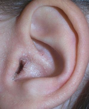 Наружный отит уха – симптомы и способы лечения воспаления