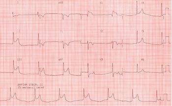 Лечение сердечного приступа – методы помощи при инфаркте сердца
