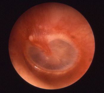 Чем проявляется отит – способы лечения воспаления среднего уха