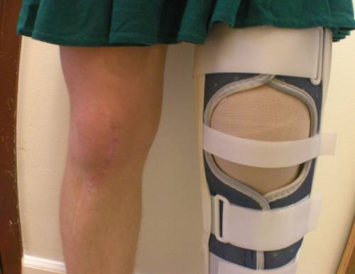 Восстановление коленного сустава после вывиха