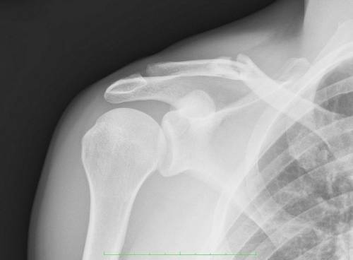 Восстановление после перелома костей ключицы – методы реабилитации