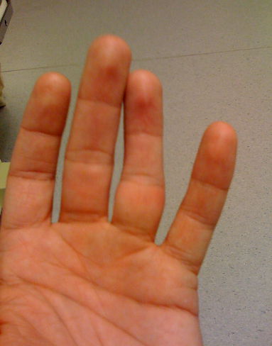 Исправление деформации пальцев при вывихе суставов фаланг