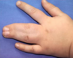 Срастание пальцев – как решить проблему перепонки между пальцами