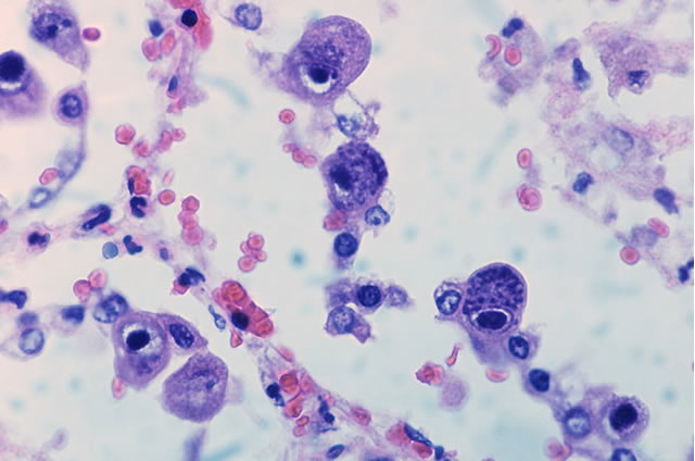 Наличие антител IgG и IgM к цитомегаловирусу – значение исследования