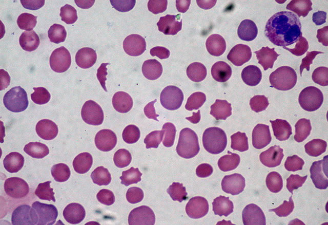 Отчего в крови снижается уровень тромбоцитов – причины тромбоцитопении