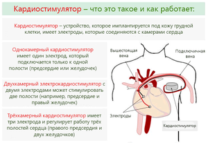 Виды кардиостимуляторов, особенности установки и жизни со стимулятором сердца