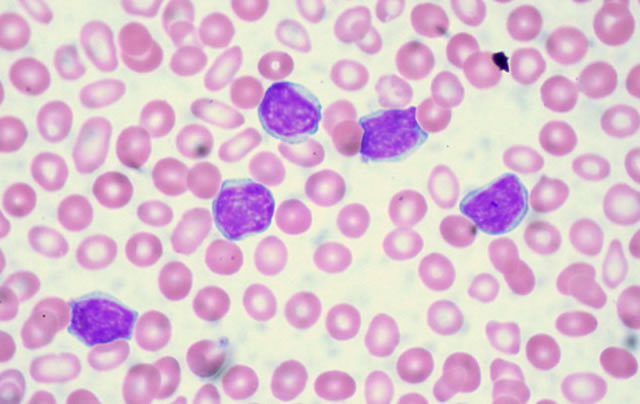 Количество лимфоцитов в крови – значение результатов исследования
