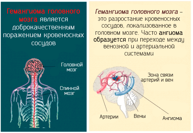 Какие симптомы имеет ангиома на головном мозге – возможности лечения
