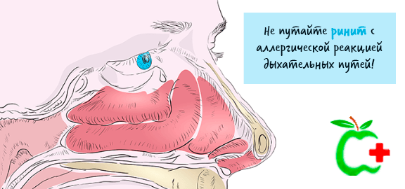 Ринит или воспаление слизистой оболочки носа – что это такое и как лечить