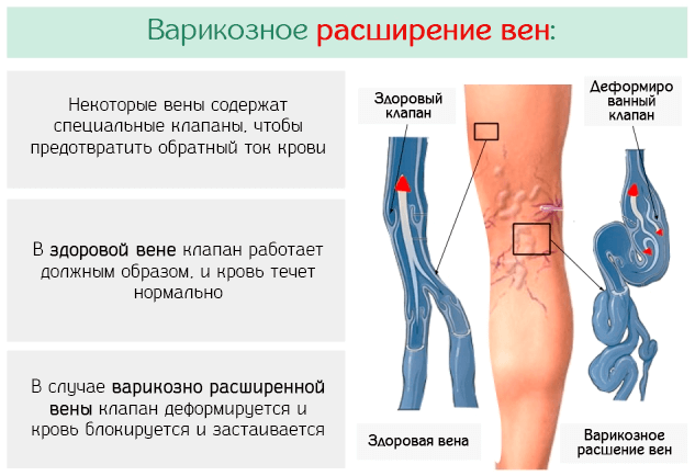 Базовые методы лечения варикозного расширения вен на ногах