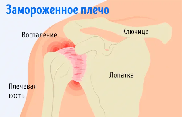 Воспаление сустава при синдроме замороженного плеча