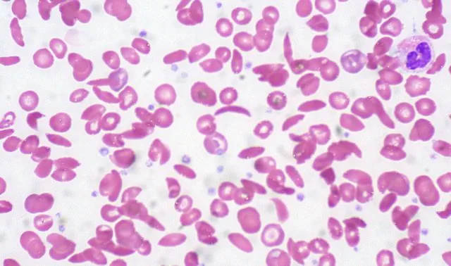 Типичные проявления анемии в клетках крови