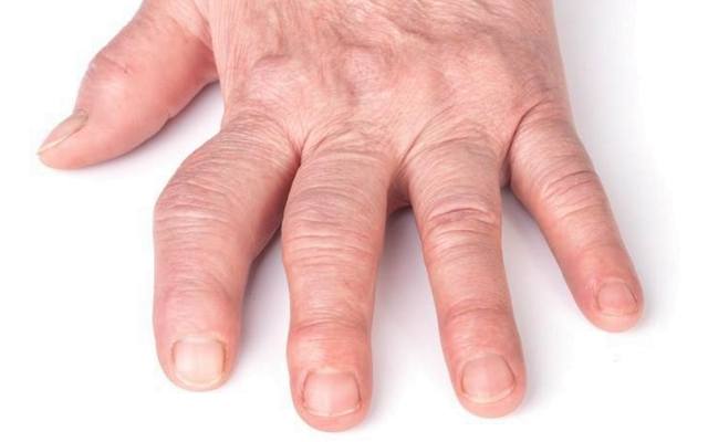 Пример прогрессирующего остеоартроза на суставах пальцев руки