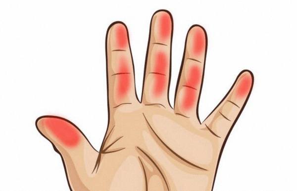 Боль в пальцах ладони – проблема с позвоночником