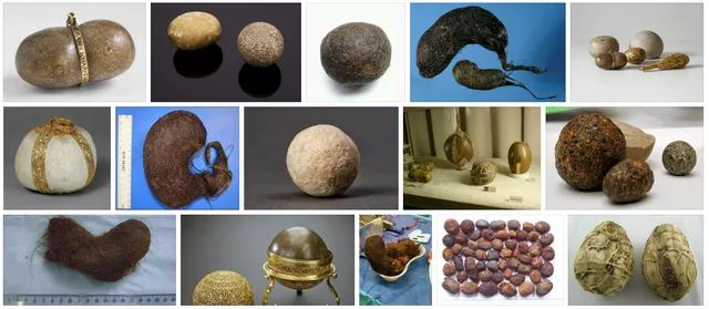 Примеры желудочных камней безоаров
